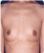 乳ガン患者の手術痕がほとんど分らない状態に再生できた（左は幹細胞液注入前、右は注入後）＜写真提供：森 正樹氏＞